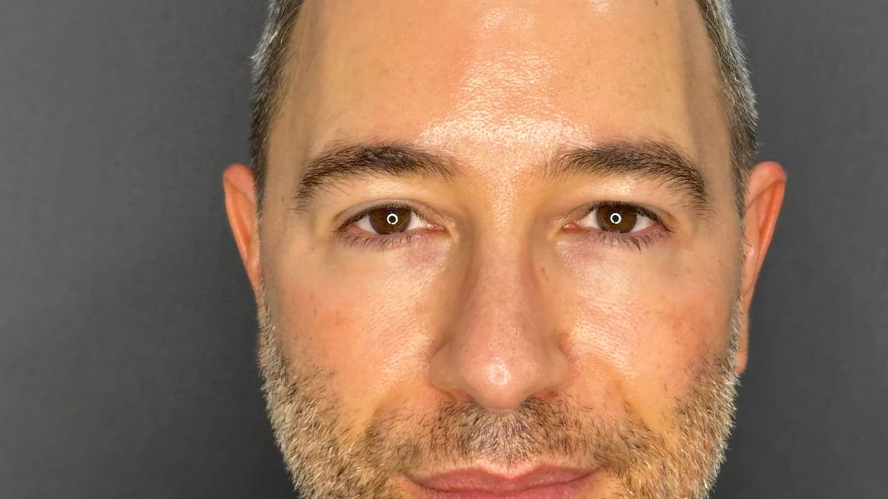 Facial Contouring after