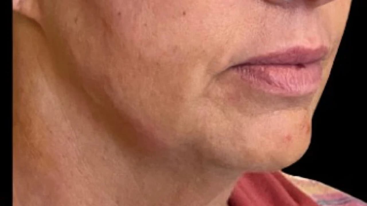 Dermal Fillers after