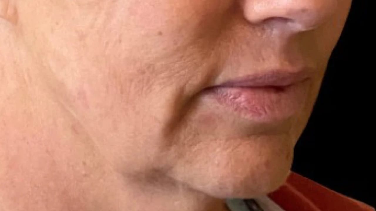 Dermal Fillers before