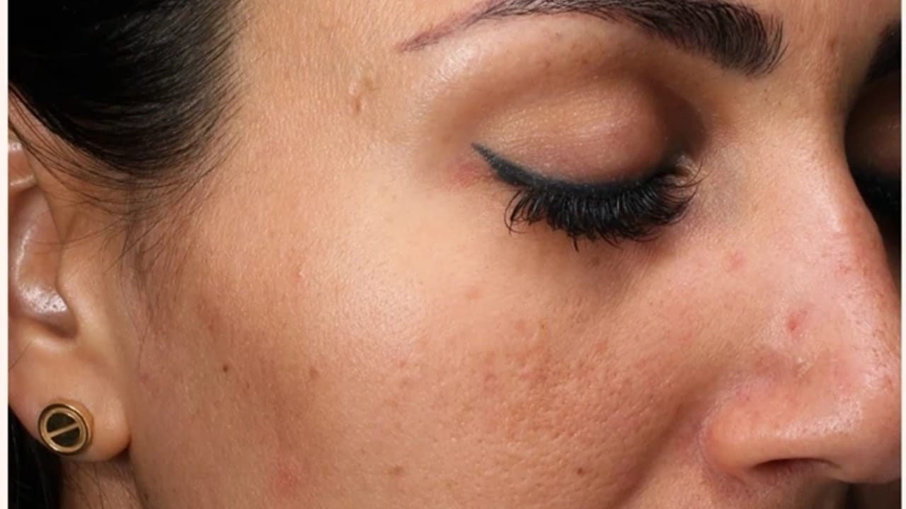 Growth Factor Induced Therapy™ before