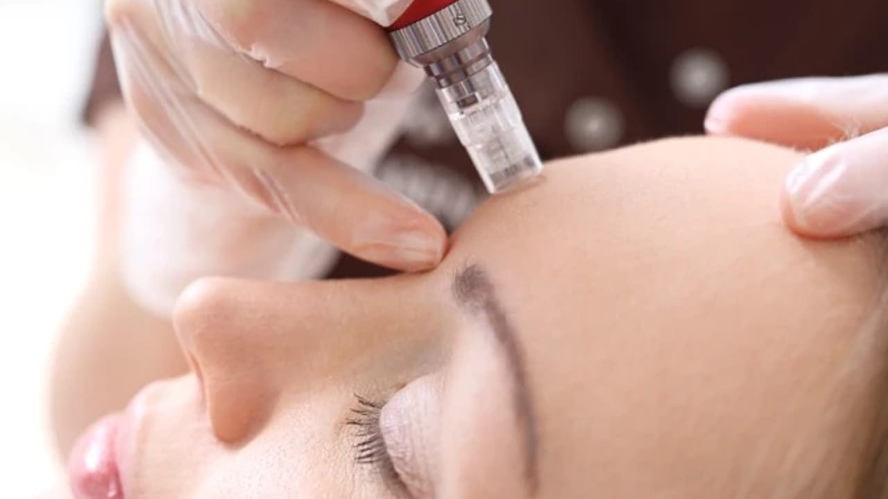 Microneedling treatment for enhancing skin texture and tone