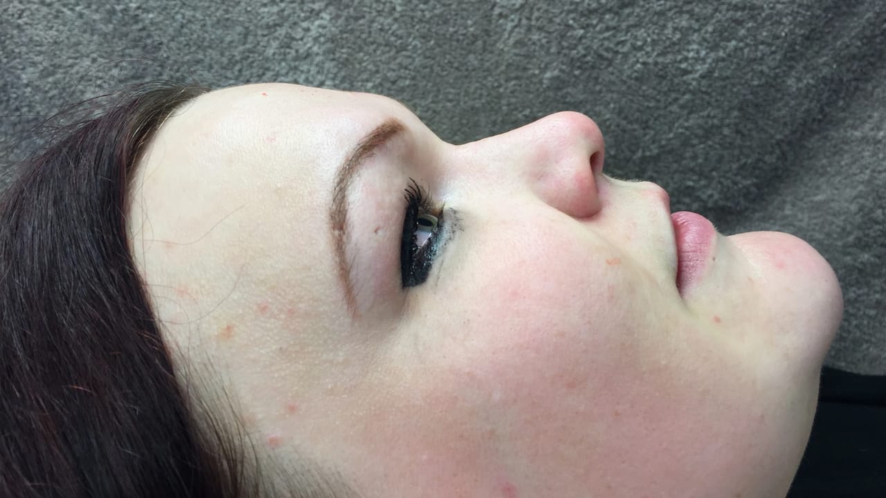 Non-Surgical Rhinoplasty after