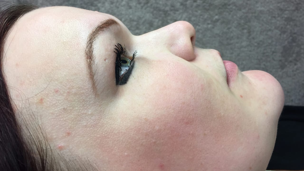 Non-Surgical Rhinoplasty before