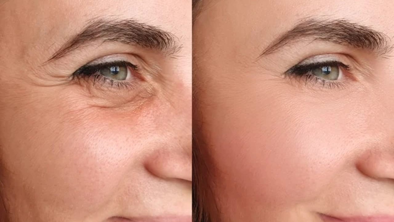 Skin tightening treatment for firming and lifting the skin